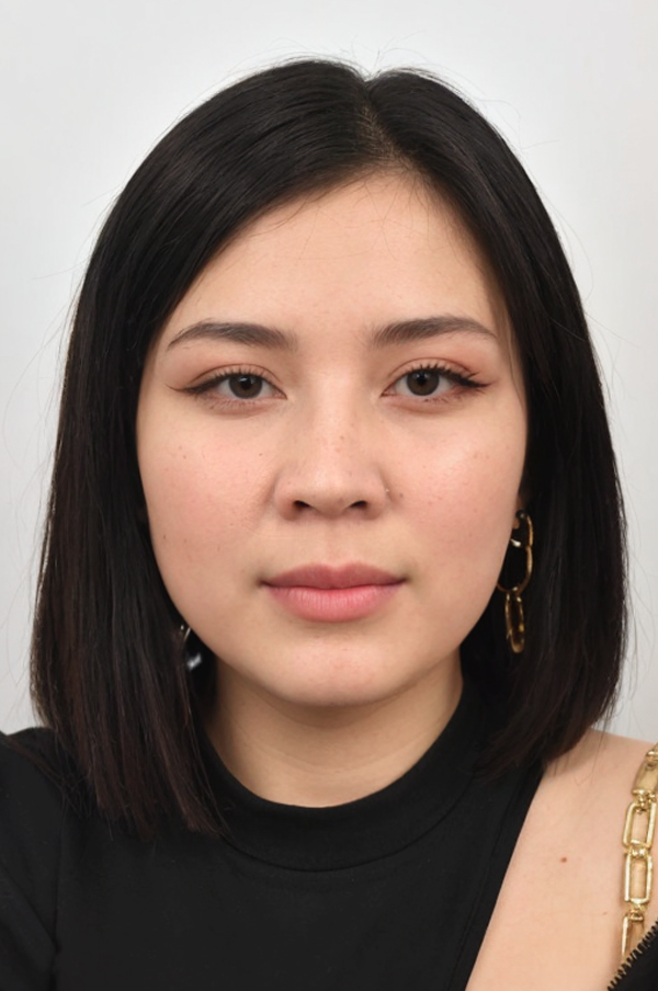 After Facelift surgery result