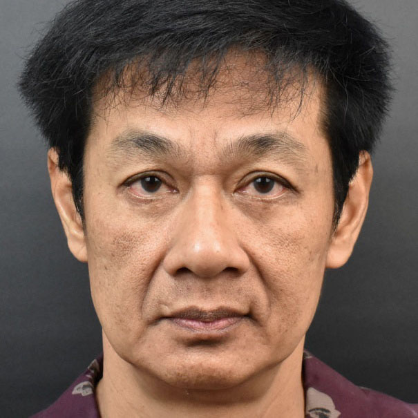 Before Facelift surgery